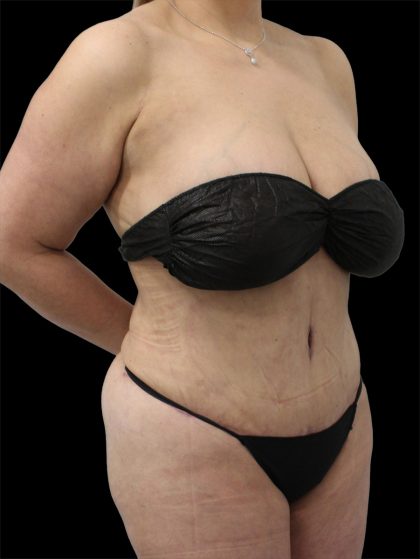 Tummy Tuck Before & After Patient #2838