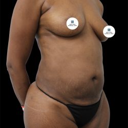 Tummy Tuck Before & After Patient #2839