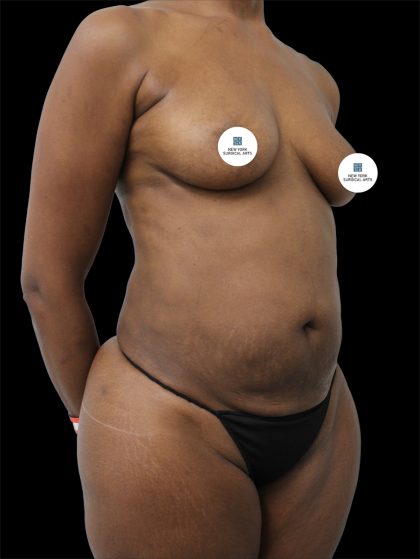 Tummy Tuck Before & After Patient #2839
