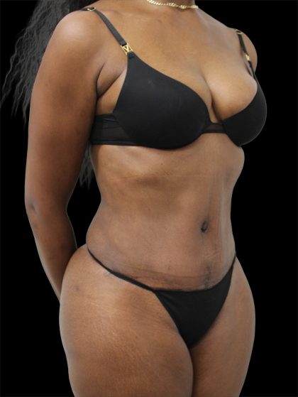 Tummy Tuck Before & After Patient #2839