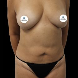 Tummy Tuck Before & After Patient #2840