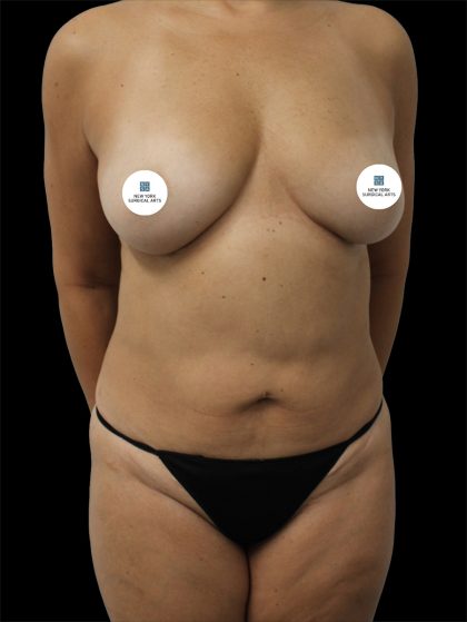Tummy Tuck Before & After Patient #2840