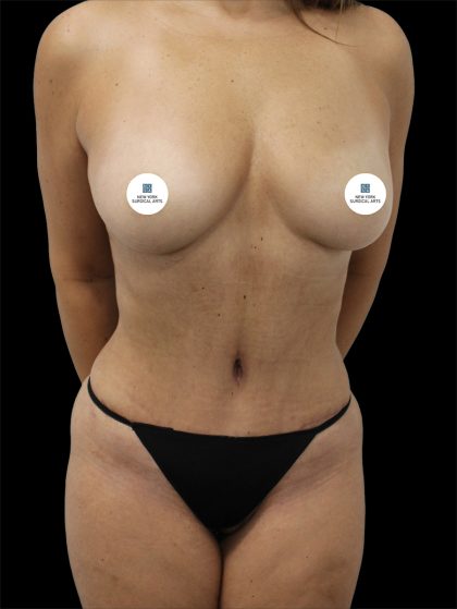 Tummy Tuck Before & After Patient #2840