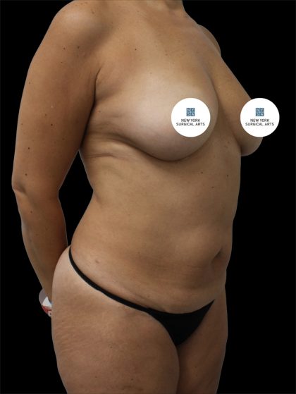 Tummy Tuck Before & After Patient #2840