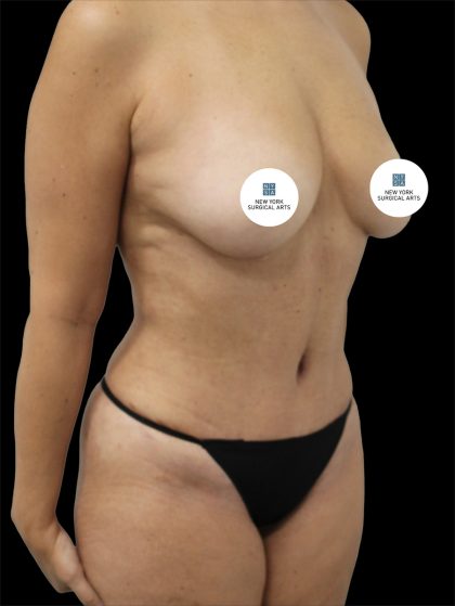 Tummy Tuck Before & After Patient #2840