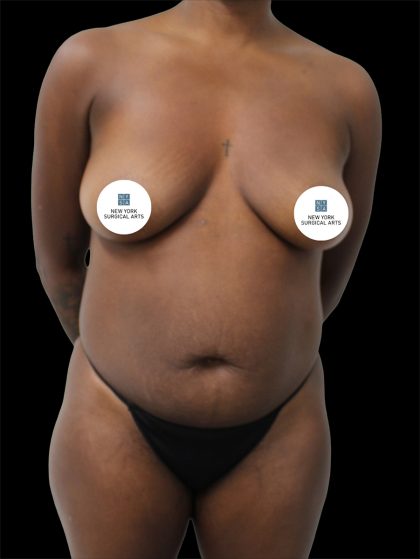 Tummy Tuck Before & After Patient #2841