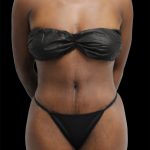 Tummy Tuck Before & After Patient #2841