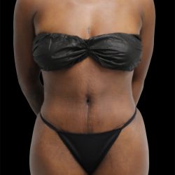 Tummy Tuck Before & After Patient #2841