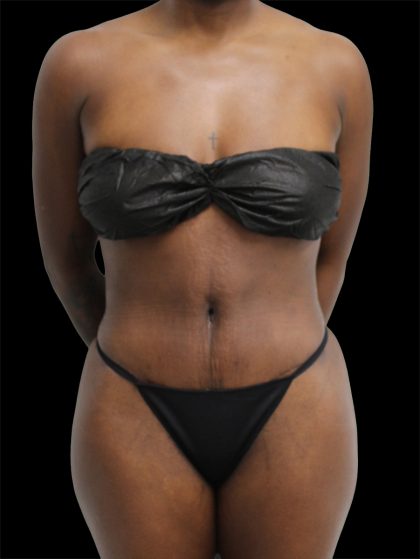 Tummy Tuck Before & After Patient #2841