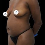 Tummy Tuck Before & After Patient #2841