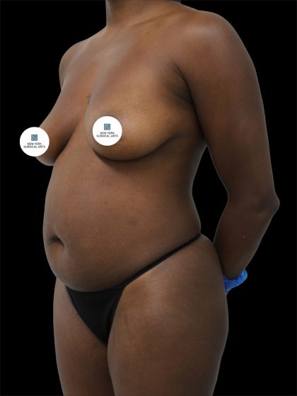 Tummy Tuck Before & After Patient #2841