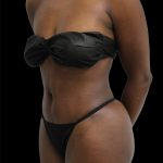 Tummy Tuck Before & After Patient #2841