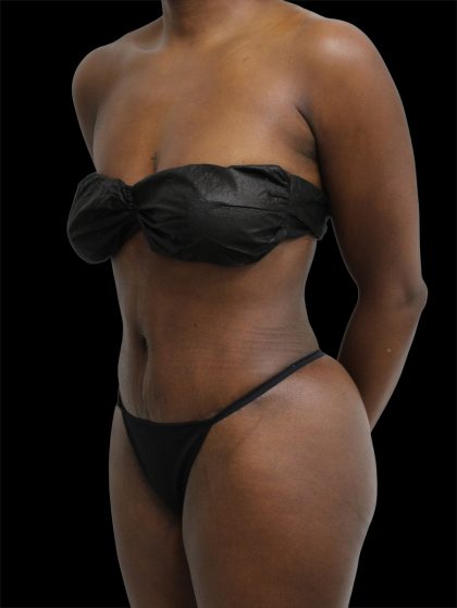 Tummy Tuck Before & After Patient #2841