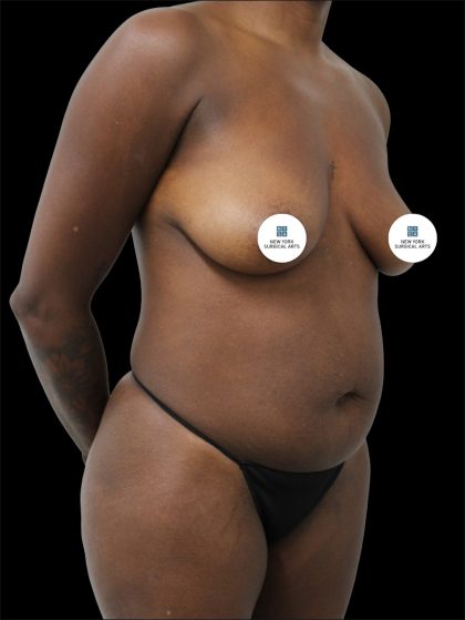 Tummy Tuck Before & After Patient #2841