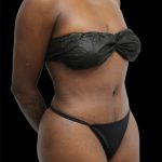 Tummy Tuck Before & After Patient #2841