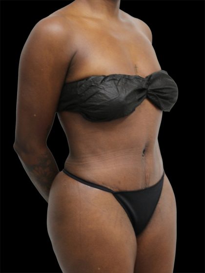 Tummy Tuck Before & After Patient #2841