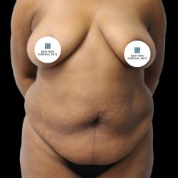 Tummy Tuck Before & After Patient #2842