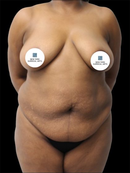 Tummy Tuck Before & After Patient #2842