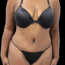 Tummy Tuck Before & After Patient #2842