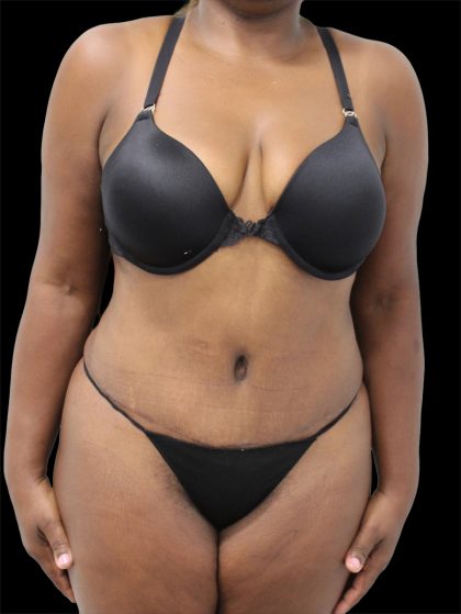 Tummy Tuck Before & After Patient #2842