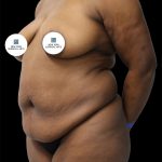 Tummy Tuck Before & After Patient #2842