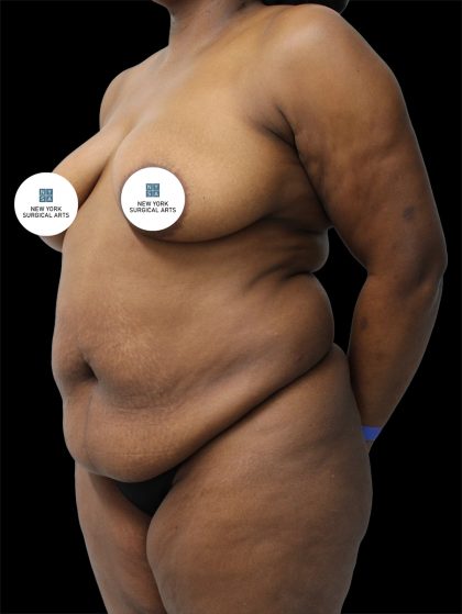 Tummy Tuck Before & After Patient #2842