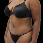 Tummy Tuck Before & After Patient #2842