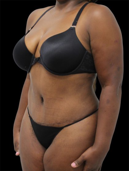 Tummy Tuck Before & After Patient #2842