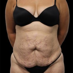 Tummy Tuck Before & After Patient #2843