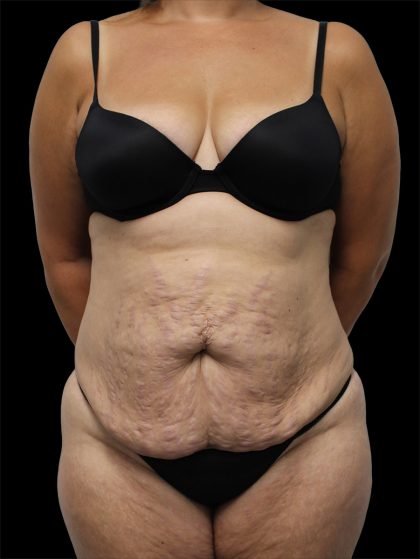 Tummy Tuck Before & After Patient #2843