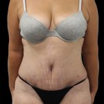 Tummy Tuck Before & After Patient #2843