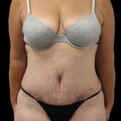 Tummy Tuck Before & After Patient #2843
