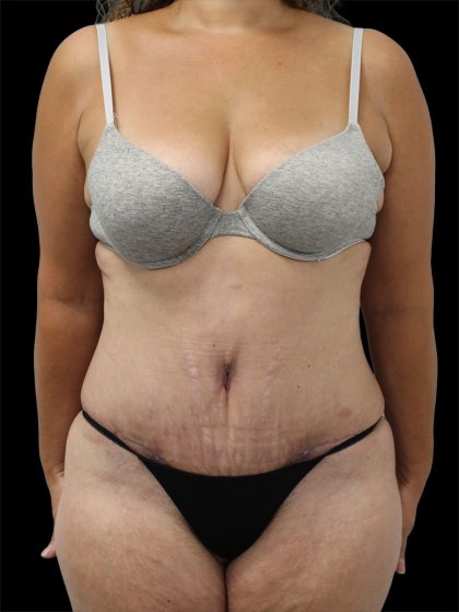 Tummy Tuck Before & After Patient #2843