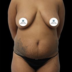 Tummy Tuck Before & After Patient #2844