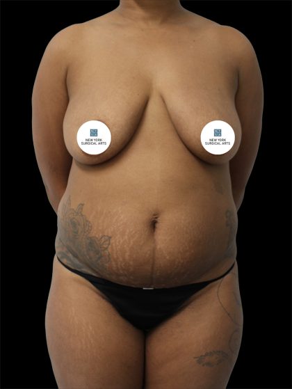 Tummy Tuck Before & After Patient #2844
