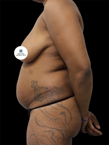 Tummy Tuck Before & After Patient #2844