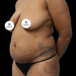Tummy Tuck Before & After Patient #2844
