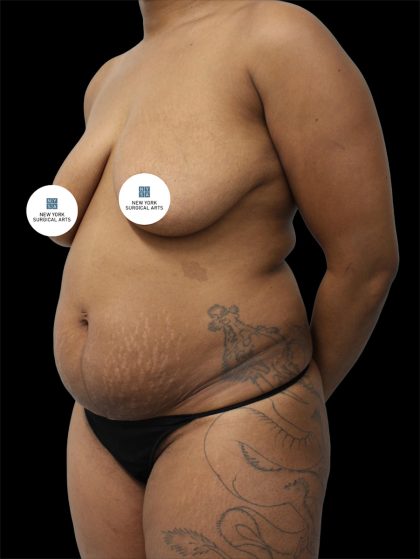 Tummy Tuck Before & After Patient #2844