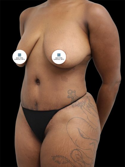 Tummy Tuck Before & After Patient #2844