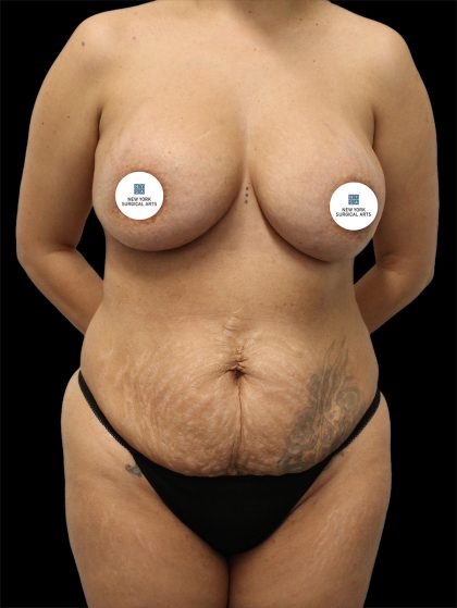 Tummy Tuck Before & After Patient #2845