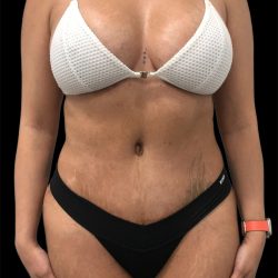 Tummy Tuck Before & After Patient #2845