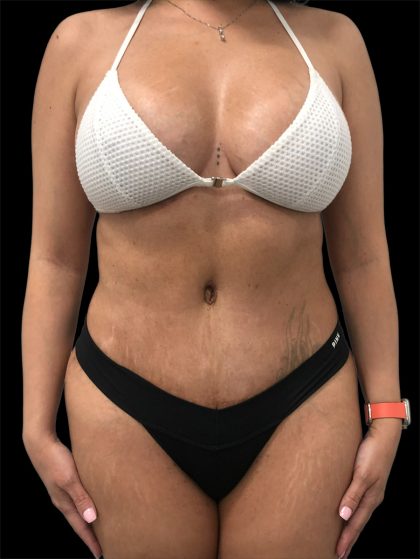 Tummy Tuck Before & After Patient #2845