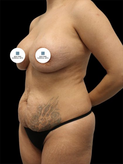 Tummy Tuck Before & After Patient #2845