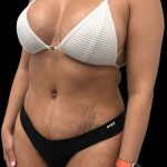 Tummy Tuck Before & After Patient #2845