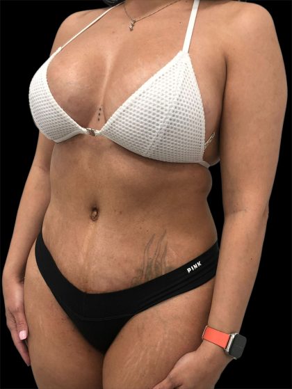 Tummy Tuck Before & After Patient #2845