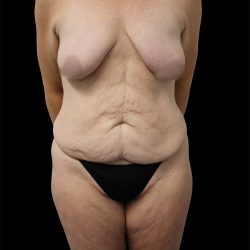 Tummy Tuck Before & After Patient #2690