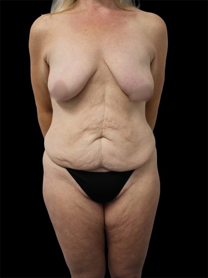 Tummy Tuck Before & After Patient #2690