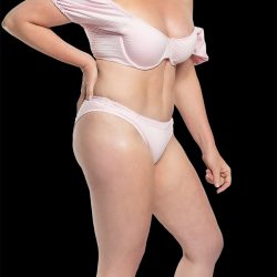 Tummy Tuck Before & After Patient #2690