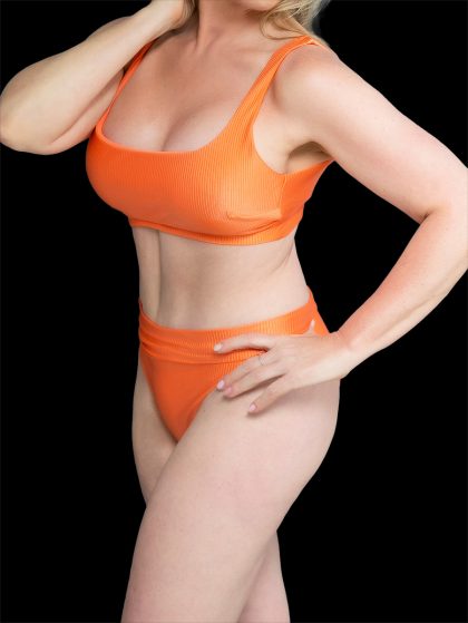 Tummy Tuck Before & After Patient #2690
