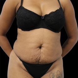 Tummy Tuck Before & After Patient #2846